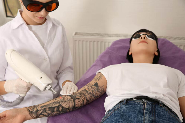 Laser Off a Tattoo